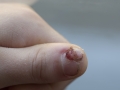 cut finger-2