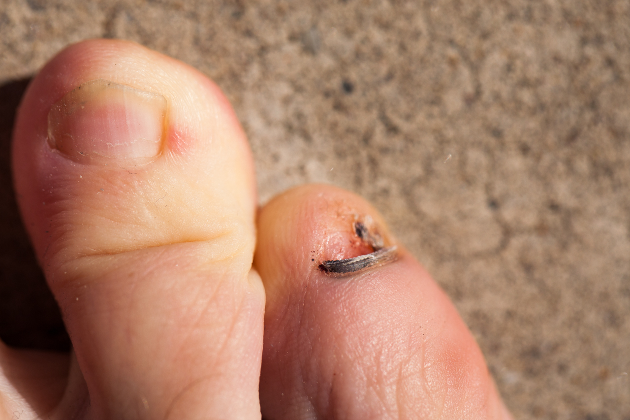 Another toe injury