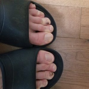 Dead Toenails